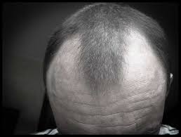 genetic baldness hair loss