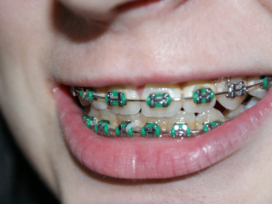 braces